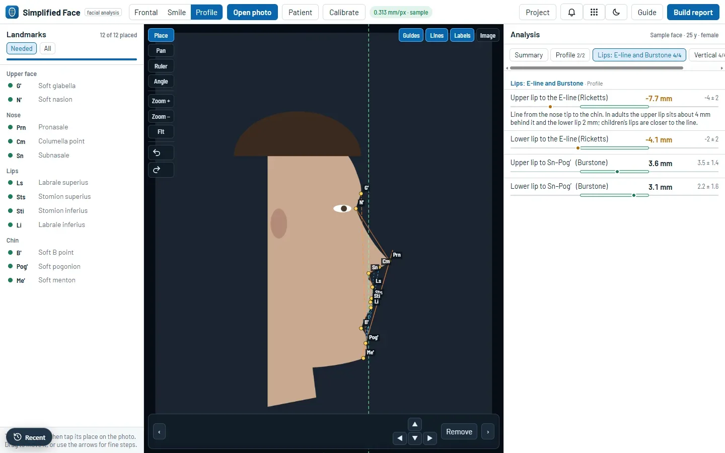 Simplified Face showing the profile of the schematic sample drawing with 12 landmarks, the landmark list on the left, and the E-line and Burstone lip measurements with their reference values on the right.