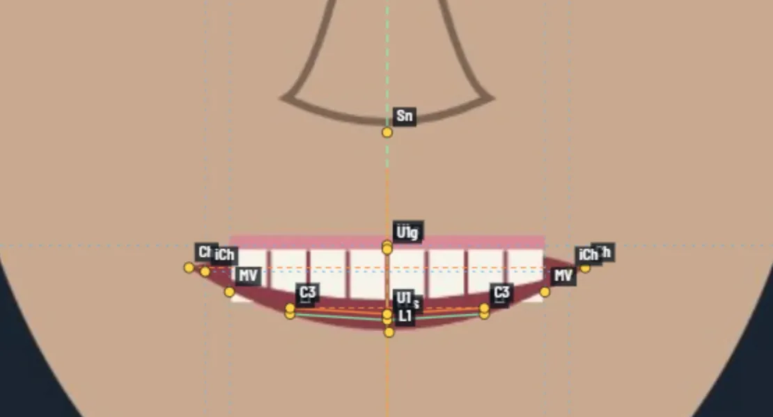 A close view of the smile in the schematic sample drawing, with landmarks on the commissures, canines, incisal edges and gingival margin.